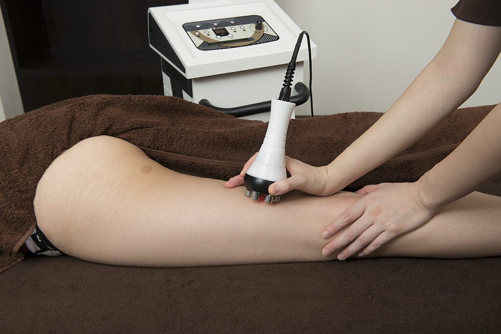 フォトギャラリー(Photo) 57 ハイパナイフを使って大腿部の脂肪を減少させる